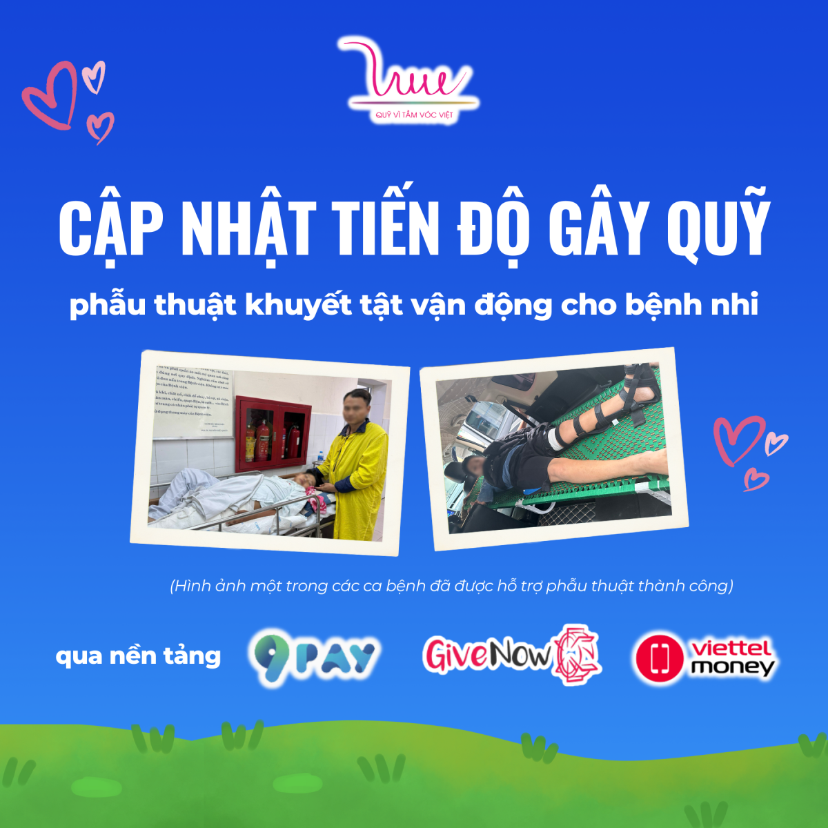 Cập nhật tiến độ gây quỹ phẫu thuật cho trẻ khuyết tật vận động